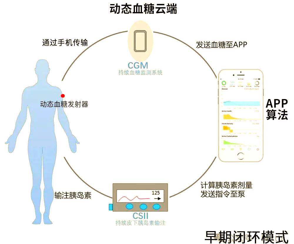 美敦力780g 革命性的閉環(huán)式胰島素泵，引領高效、穩(wěn)定與精確的糖尿病管理